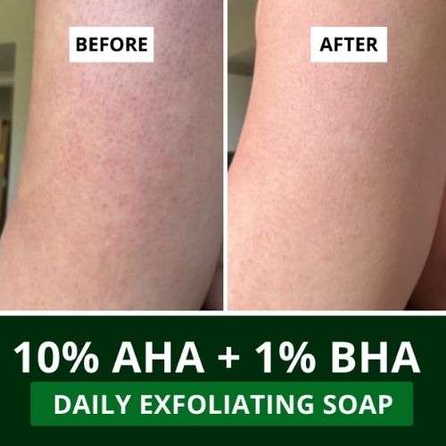 Bake Cosmetics: 10% AHA + 1% BHA Scrub Treatment Soap with Lactic Acid For Clogged Pores, Exfoliation, Strawberry Skin & Bright Underarms-Pack of 3(100g x 3)