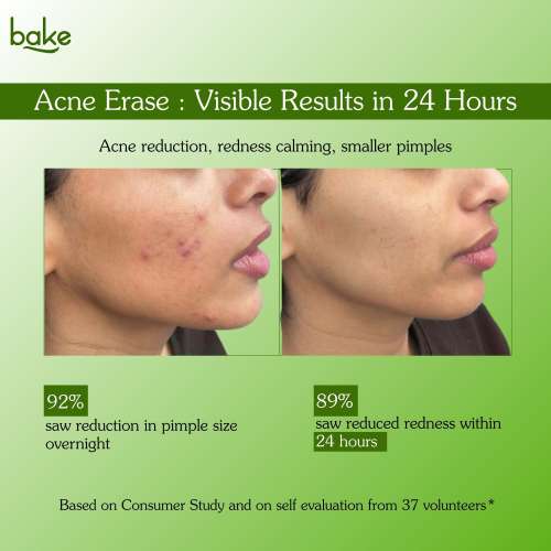Bake Cosmetics: 2% Salicylic Acid Acne Spot Serum Gel -Overnight Acne Corrector for Pimples, Breakouts, Redness & Clogged Pores  30gm