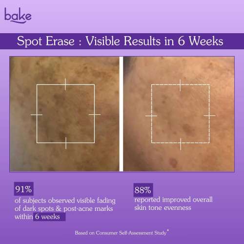 Bake Cosmetics: Spot Erase Dark Spot Correcting Serum Cream with 3% Kojic Acid for Post Acne Marks, Melasma & Pigmentation  30gm