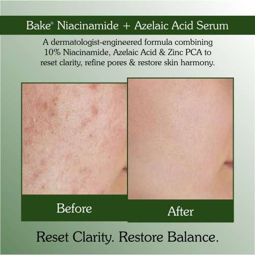 Bake Cosmetics: 10% Niacinamide + Azelaic Acid + 2% Kojic Acid Serum: Fades Acne Marks, Spots & Open Pores 30ml