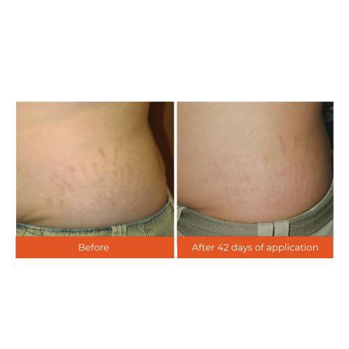 Skinvest: Bomb Bum Cream for Stretch Marks & Cellulite | Pregnancy-Safe Body Tightening Cream with Caffeine & Peptides | Built-In 5-Ball Massager for Firming, Smoothing & Elasticity | 100ml