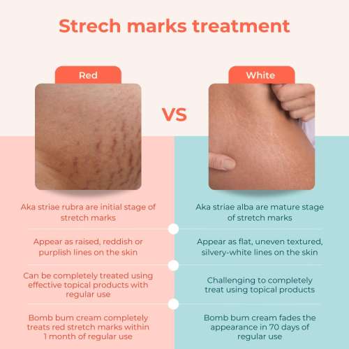 Skinvest: Bomb Bum Cream for Stretch Marks & Cellulite | Pregnancy-Safe Body Tightening Cream with Caffeine & Peptides | Built-In 5-Ball Massager for Firming, Smoothing & Elasticity | 100ml