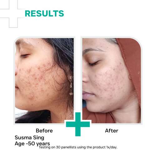 Dermatouch: Salicylic Acid 2% Niacinamide 6% Anti-Acne Oil Free Gel - 70gm