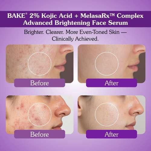 Bake Cosmetics: 2% Kojic Acid Face Serum with MelasaRx Complex for Dark Spots, Pigmentation & Brightening Glow 30ml