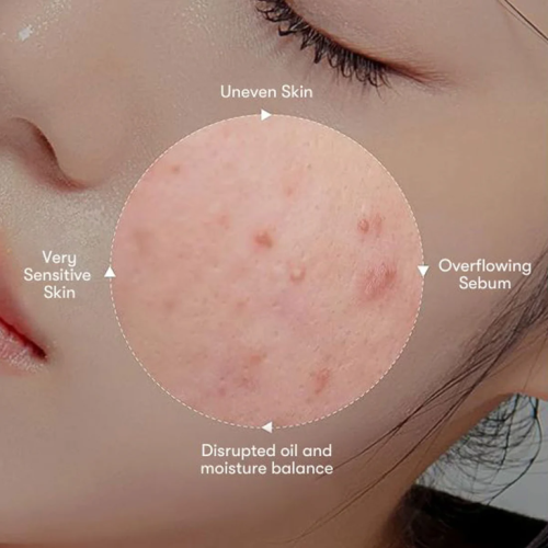 VT Cosmetics: Azelaic Acid Mask  30Ea