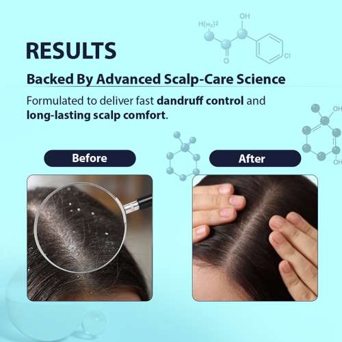 Dermistry: Anti Dandruff Shampoo Piroctone Climbazole ZPTO for Oily Itchy Flaky Scalp Dry Frizzy Hair 200ml