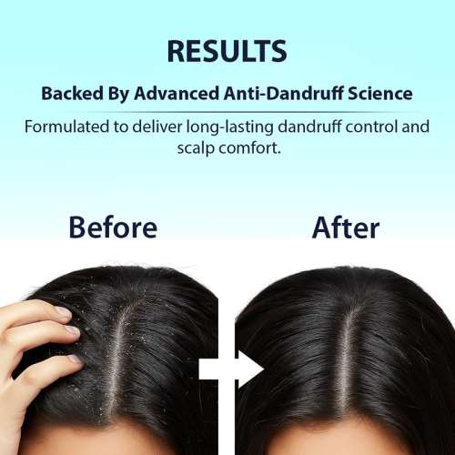 Dermistry: Anti Dandruff Hair Mask Piroctone Climbazole & ZPTO Treatment for Flakes Dry Itchy Scalp 200ml