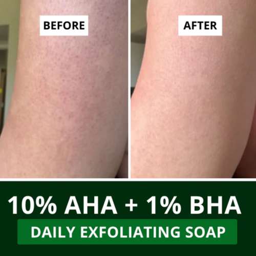 Bake Cosmetics: 10% AHA + 1% BHA Scrub Treatment Soap with Lactic Acid For Clogged Pores, Exfoliation, Strawberry Skin & Bright Underarms Pack of 4(100gm x 4)