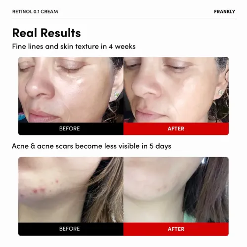 Frankly: Retinol 0.1% Cream | Anti-Aging | Wrinkle Care | Vitamin A | Vitamin E | Fine Lines | Beginner Retinol | Pore Refining | Korean Skincare | 30ml