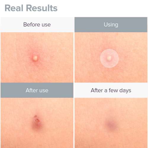 Priveda: Spot Clearing Acne Pimple Patch - 57 Patches