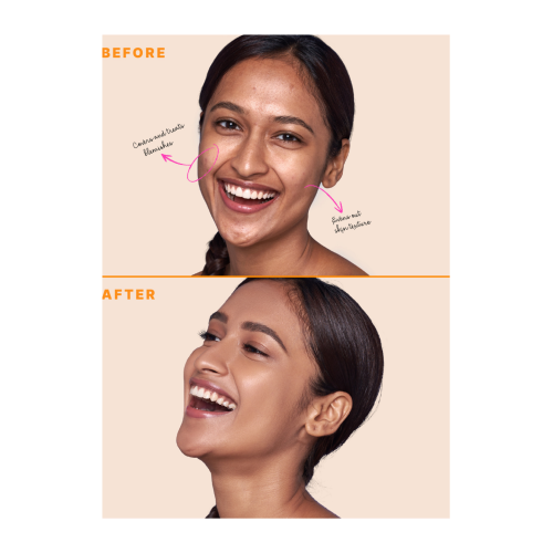 Type Beauty: Zit Quit Concealer, For Acne & Uneven Texture - Caramel - 8Ml