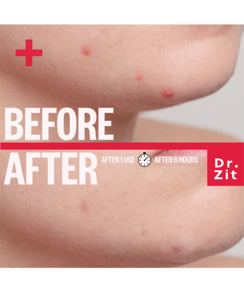 Spot Patch: Dr Zit 42 Acne Pimple Patches - 42 Pcs