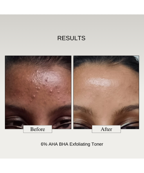 The FormulaRX: 6% AHA BHA Exfoliator (5% Glycolic & 1% Salicylic Acid) Exfoliating Serum For Whiteheads, Enlarged Pores, Dark Spots