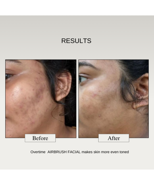 The FormulaRX: Air Brush Facial - All In One 10% Lactic Acid Exfoliating, Glowing & Brightening Serum For all skin types