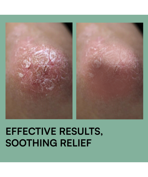 Brinton: Psoramist Moisturizing Cream  150gm