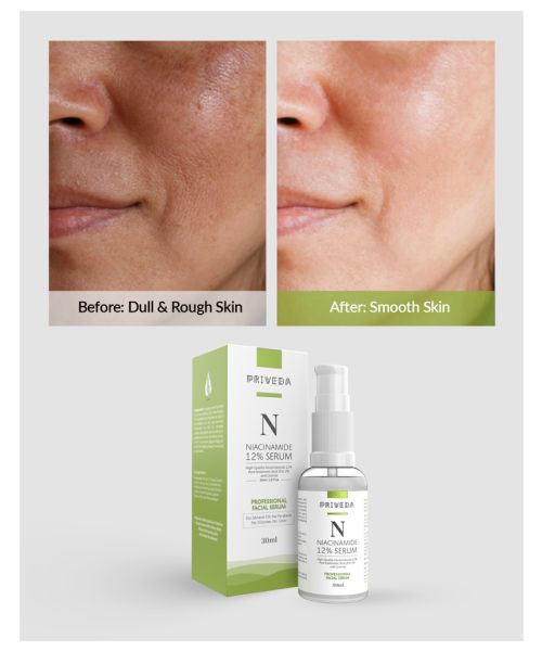 Priveda: Niacinamide Face Serum For Acne Marks And Acne Prone Skin For Men and Women - 30ml