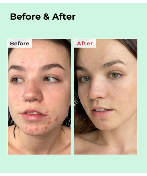 COSRX: BHA Blackhead Power Liquid Exfoliant Essence | 100ml