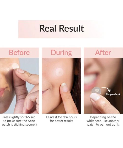 Priveda: Acne Pimple Patch - Absorbing Hydrocolloid Spot Treatment - 57 Patches