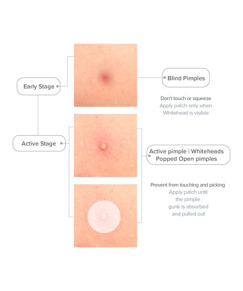 Priveda: Spot Clearing Acne Pimple Patch - 57 Patches