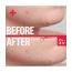Spot Patch: Dr Zit 42 Acne Pimple Patches - 42 Pcs