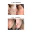 SKOG: Acne Clarifying Gel - 30ml