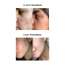 SKOG: Acne Clarifying Gel - 30ml