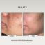 The FormulaRX: Hydra Veil Gel Moisturizer - Malazia - Oil free For Oily, Very Oily, Combination, Acne and fungal acne prone, Sensitive Skin