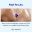 One-Day's You: P.Z. SSOC SSOC No More Blackhead