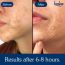 Bake Cosmetics: 2% Salicylic Acid Hydrocolloid Acne Absorbing Surface Patch XL Pimple Patches for Blackheads Removal ,Pore Cleansing & Reduces Whiteheads -Pack Of 10 Strips