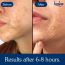 Bake Cosmetics: 2% Salicylic Acid Hydrocolloid Acne Absorbing Surface Patch XL Pimple Patches for Blackheads Removal ,Pore Cleansing & Reduces Whiteheads -Pack Of 4 Strips
