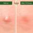 Bake Cosmetics: Zit Erase Micro point Patches   Pack of 9 Patches  30gm