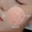 VT Cosmetics: Azelaic Acid Mask  30Ea
