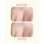 Priveda: Spot clearing Patch, Hydrocolloid Large Acne Pimple Patch Spot Treatment - 10 Patches